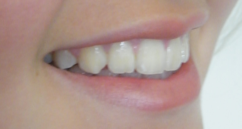 veneers